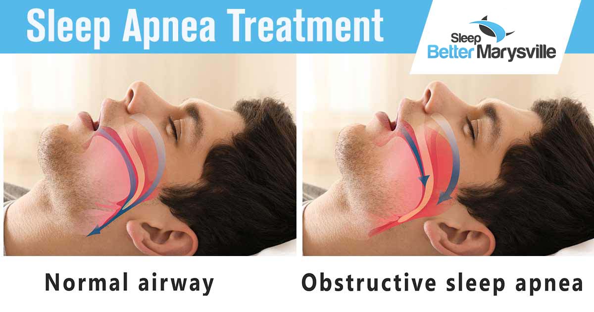 Sleep Better Marysville - a man laying in bed with overlay of a normal airway versus one with obstructive sleep apnea. People are becoming increasingly aware of the effects of sleep apnea on quality of life, but many don't know where to start with treatment options. Your sleep quality may be getting worse, but now is the time to take care of it.