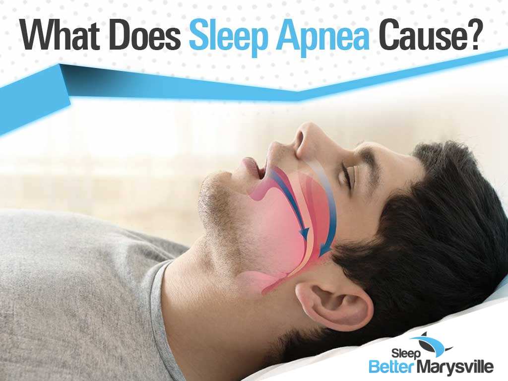 Man sleeping with his mouth open, featured in Sleep Better Marysville's section on what sleep apnea causes.